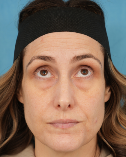 Lower Blepharoplasty Before & After Patient #3263