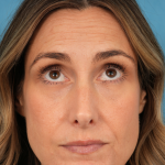 Lower Blepharoplasty Before & After Patient #3263