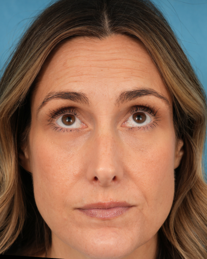 Lower Blepharoplasty Before & After Patient #3263