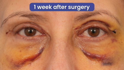 Quad Blepharoplasty Before & After Patient #3239