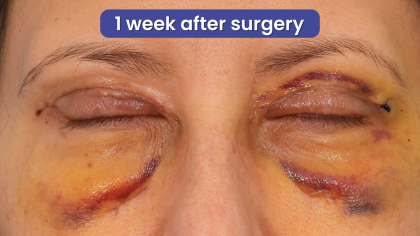 Quad Blepharoplasty Before & After Patient #3239