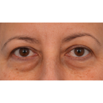 Quad Blepharoplasty Before & After Patient #3239