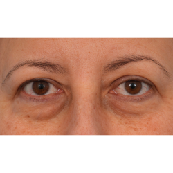 Quad Blepharoplasty Before & After Patient #3239