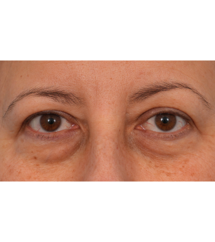 Quad Blepharoplasty Before & After Patient #3239
