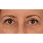 Quad Blepharoplasty Before & After Patient #3239