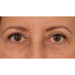Quad Blepharoplasty Before & After Patient #3239