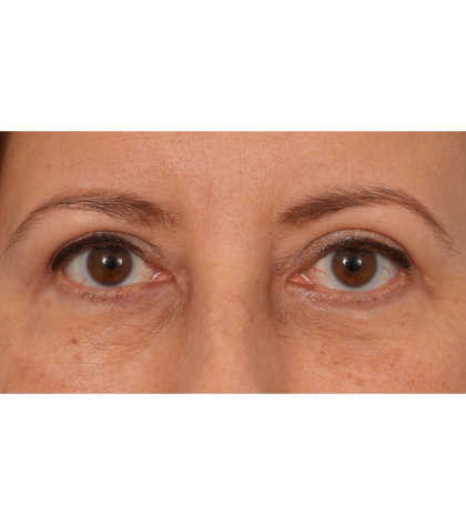 Quad Blepharoplasty Before & After Patient #3239