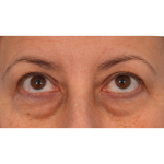 Quad Blepharoplasty Before & After Patient #3239