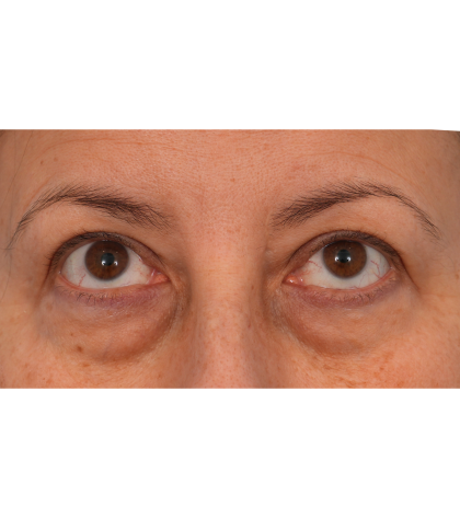 Quad Blepharoplasty Before & After Patient #3239