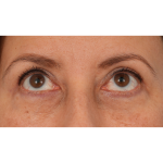 Quad Blepharoplasty Before & After Patient #3239