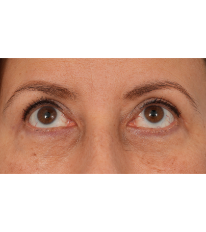 Quad Blepharoplasty Before & After Patient #3239