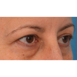 Quad Blepharoplasty Before & After Patient #3239