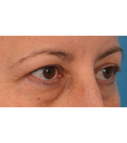 Quad Blepharoplasty Before & After Patient #3239