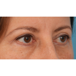 Quad Blepharoplasty Before & After Patient #3239