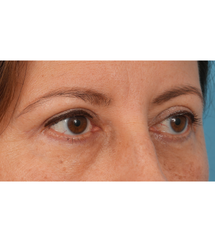 Quad Blepharoplasty Before & After Patient #3239