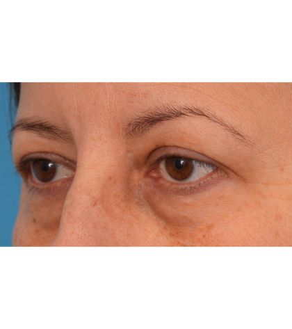 Quad Blepharoplasty Before & After Patient #3239