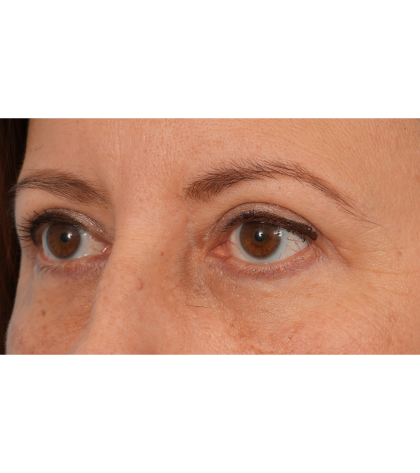 Quad Blepharoplasty Before & After Patient #3239