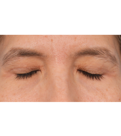 Quad Blepharoplasty Before & After Patient #3331