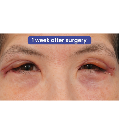 Quad Blepharoplasty Before & After Patient #3331