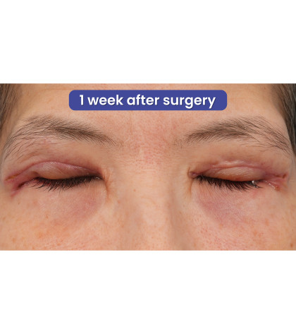 Quad Blepharoplasty Before & After Patient #3331