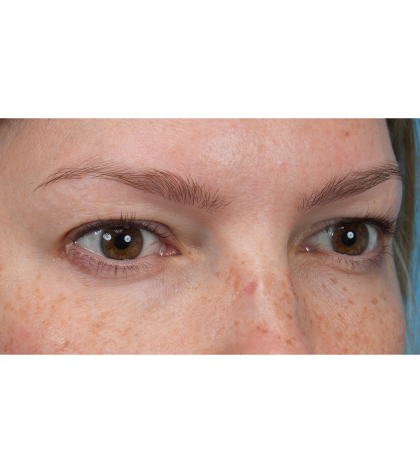 Upper Blepharoplasty Before & After Patient #3293