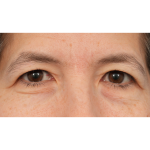 Quad Blepharoplasty Before & After Patient #3331