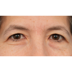 Quad Blepharoplasty Before & After Patient #3331