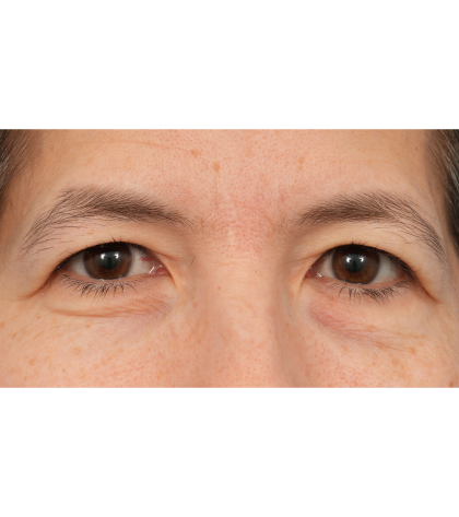 Quad Blepharoplasty Before & After Patient #3331