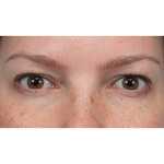 Upper Blepharoplasty Before & After Patient #3293
