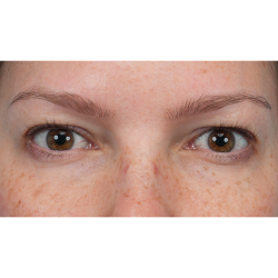 Upper Blepharoplasty Before & After Patient #3293