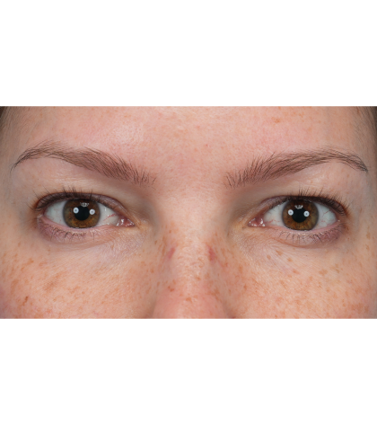 Upper Blepharoplasty Before & After Patient #3293