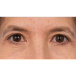 Quad Blepharoplasty Before & After Patient #3331