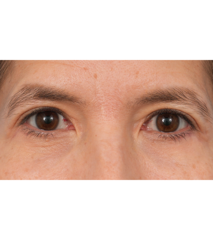 Quad Blepharoplasty Before & After Patient #3331