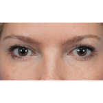 Upper Blepharoplasty Before & After Patient #3293