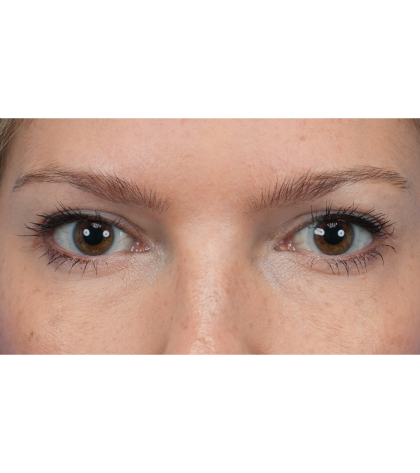 Upper Blepharoplasty Before & After Patient #3293