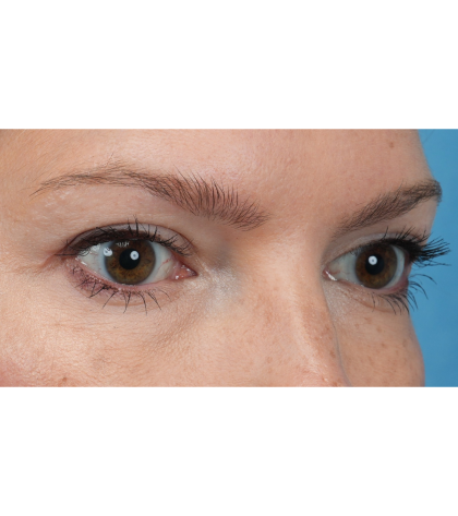Upper Blepharoplasty Before & After Patient #3293