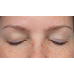 Upper Blepharoplasty Before & After Patient #3293