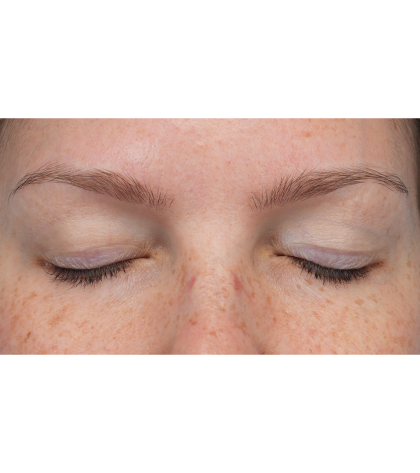 Upper Blepharoplasty Before & After Patient #3293