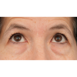 Quad Blepharoplasty Before & After Patient #3331