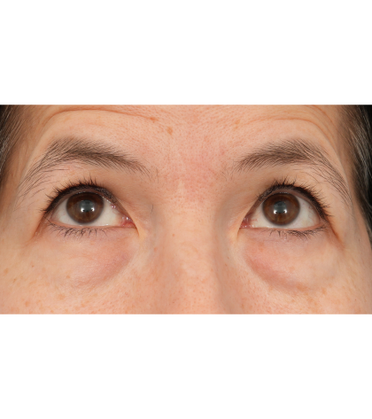 Quad Blepharoplasty Before & After Patient #3331