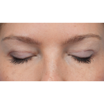 Upper Blepharoplasty Before & After Patient #3293