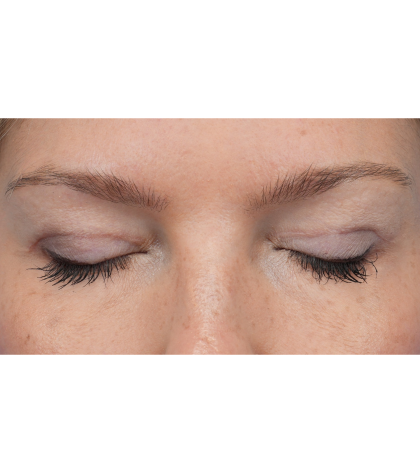 Upper Blepharoplasty Before & After Patient #3293