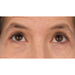 Quad Blepharoplasty Before & After Patient #3331