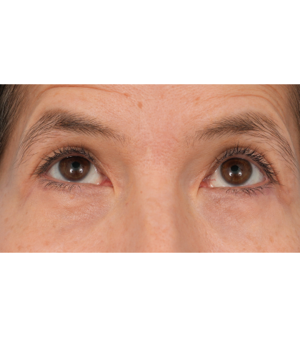 Quad Blepharoplasty Before & After Patient #3331
