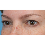 Upper Blepharoplasty Before & After Patient #3293