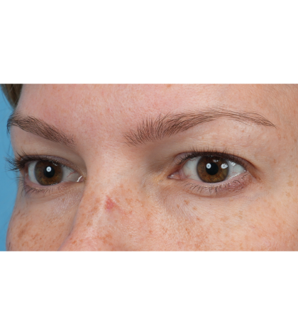 Upper Blepharoplasty Before & After Patient #3293