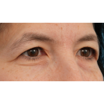 Quad Blepharoplasty Before & After Patient #3331