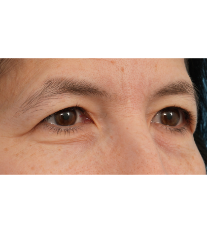 Quad Blepharoplasty Before & After Patient #3331
