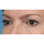 Upper Blepharoplasty Before & After Patient #3293