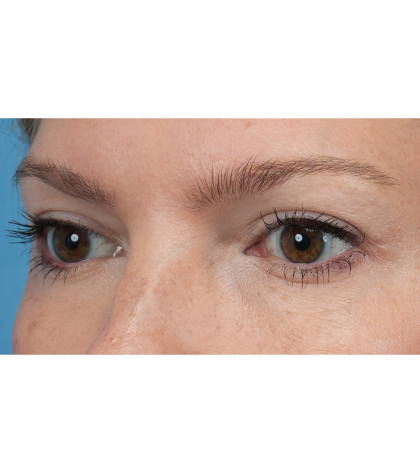 Upper Blepharoplasty Before & After Patient #3293